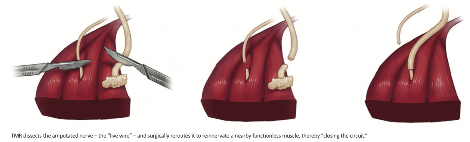 Targeted Muscle Reinnervation: Innovative Surgery Is Shown to Reduce Phantom Pain
